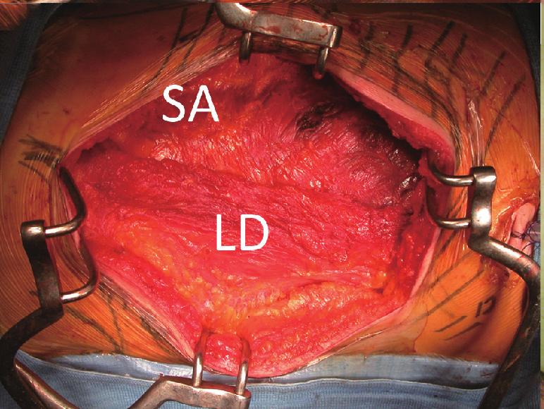 A relatively wider dissection can predispose an individual to develop a subcutaneous seroma (10); therefore, suturing the skeletal muscle fascia to the subcutaneous tissue of the chest wall and