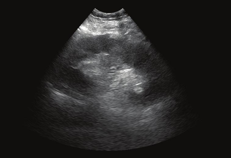 Case 2 Intraperitoneal kidney transplant Imaging kidney transplant patients requires high-quality images and Doppler sensitivity, which can be particularly difficult on kidneys that are deeper and