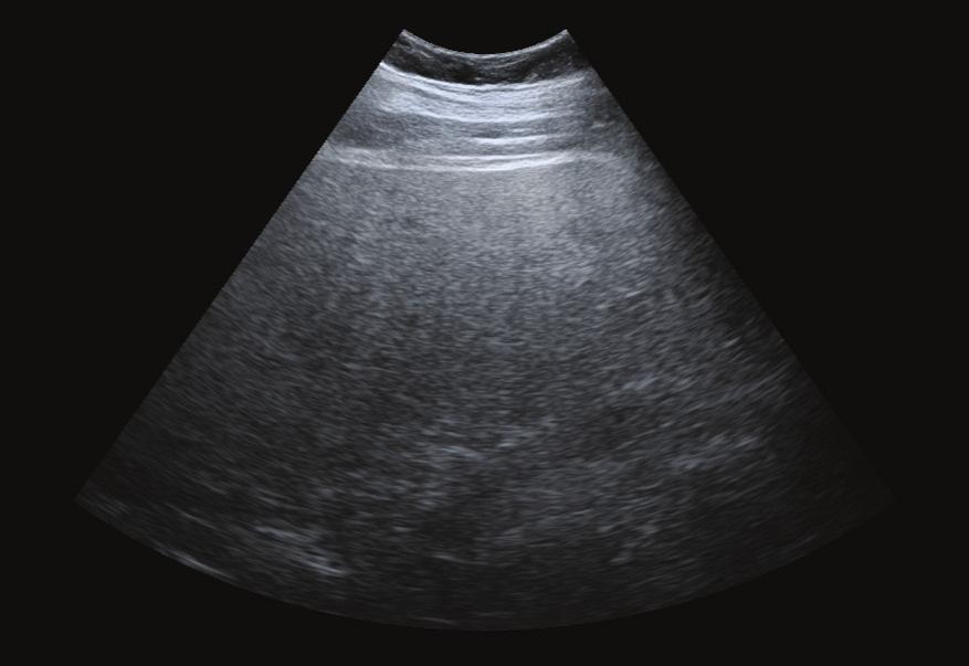 Case 3 Non-alcoholic fatty liver disease Fatty, attenuating livers have traditionally proven problematic for ultrasound.
