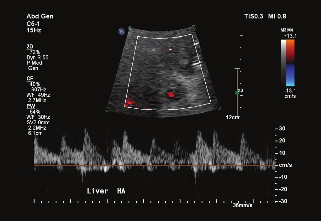Using the reference ultrasound system, the team was able to identify the remaining left lobe but nothing else. The lack of identified Doppler flow raised concerns among the surgical team.