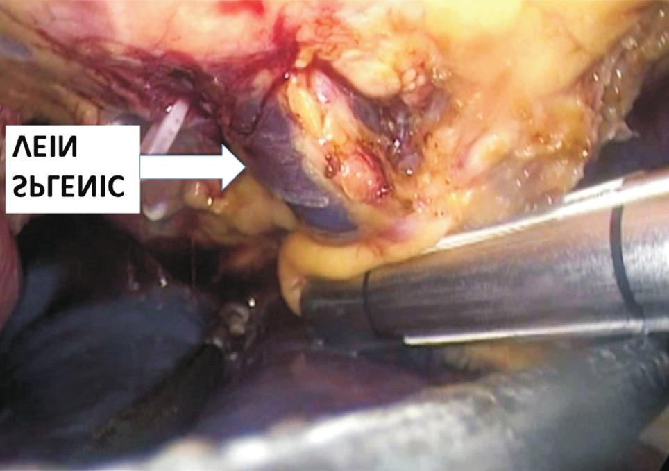 Laparoscopy for Splenic and Liver Hydatidosis border of the pancreatic tail. It was subsequently dissected and secured using Hem-o-Lok clips (Fig. 3).