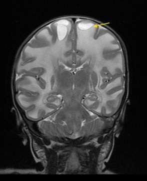 Fig 1G : Note sparing of midbrain (asterisk).