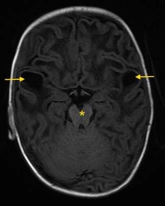 Fig 2A : Axial T1 MRI brain showing bilateral temporal subcortical cysts (arrows) which are CSF intense.