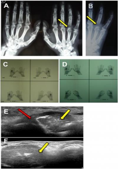 Figure 1 Figure 2 Figure 1: Radiographic view one month after onset of pain in the right ring finger with destruction of the base of the proximal phalanx (A, yellow arrow), radiographs 3 weeks later