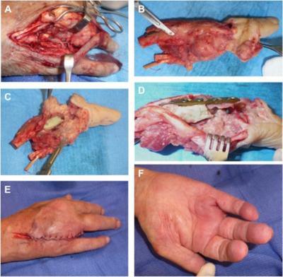 Figure 5 Figure 5: Intraoperative findings at revision surgery. Expansive tumor recurrence with infiltration of the soft tissues around the bone cement arthrodesis along the 4 ray (A).