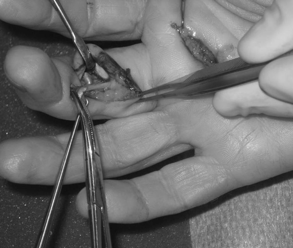 S. N. Husain et al Figure 1. Identification of ulnar slip of flexor digitorum superficialis tendon, clamped in hemostat. was performed with nylon horizontal mattress sutures.