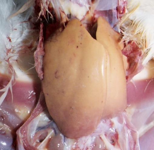 Tumourous nodules in liver Atrophy of spleen Haemorrhage