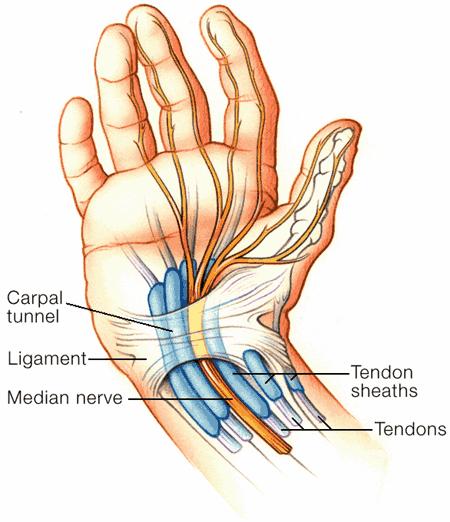 the median nerve. Some patients experience a decrease in the size of the carpal tunnel. This is most often associated with fractures or dislocations of the distal radius and/or wrist.