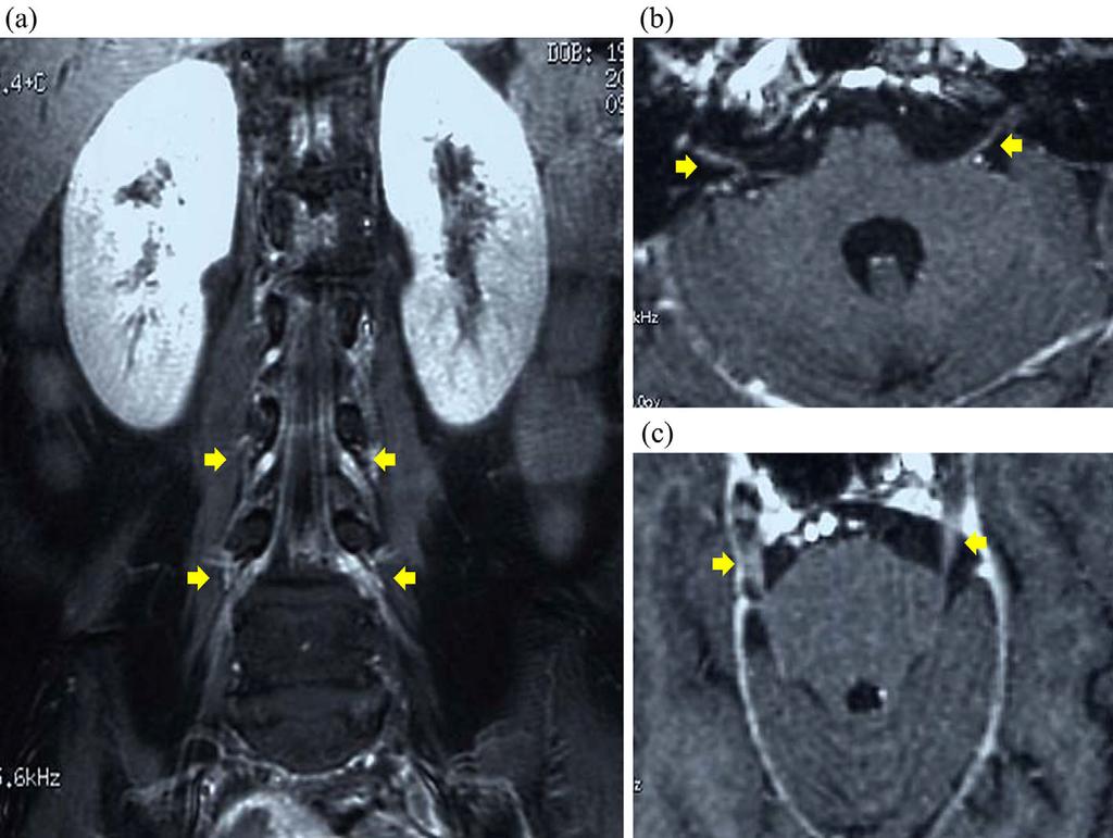Figure 1. The MRI findings. T1-weighted MRI with contrast agent in the most advanced stage at 7 months from admission.