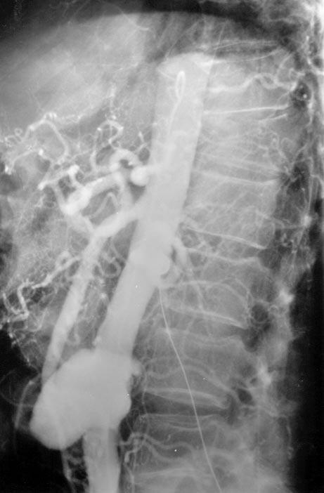 Volume 29, Number 2 Seelig et al 379 Fig 2. Computed tomographic scan of saccular mycotic aneurysm.