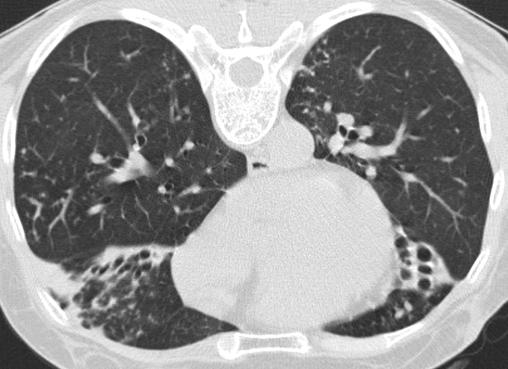 YS Kwon et al. A B Figure 4. Non-cavitary nodular bronchiectatic form of pulmonary disease caused by Mycobacterium intracellulare in a 57-year-old female patient.