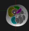 Muscle Pathology: Reduced Fat Infiltration Preliminary MRI data suggest reduced fat infiltration.