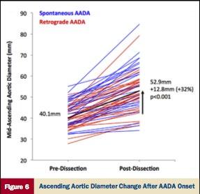 The Sizing Problem Average increase greatest in ascending aorta 32%