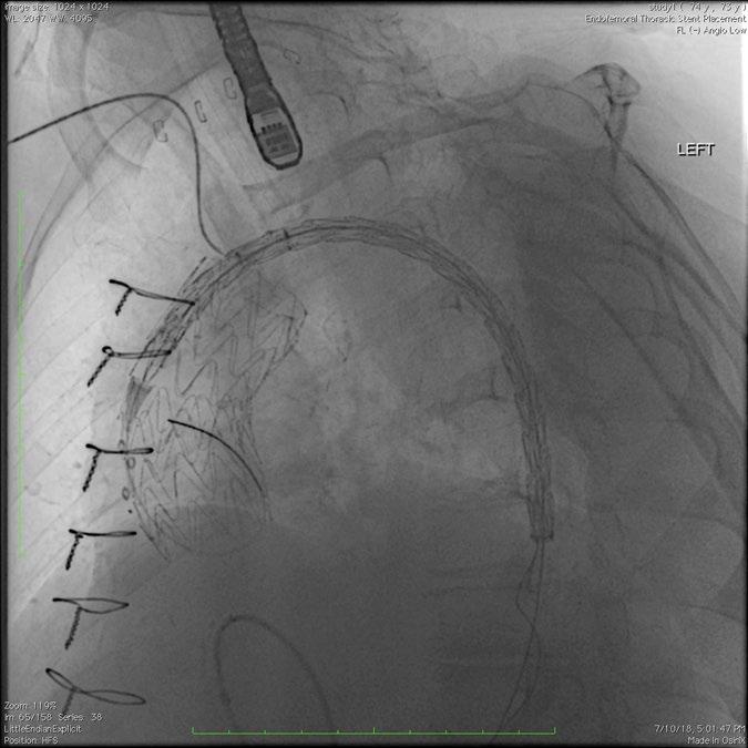 Deployment of TBE Component Size to total aortic diameter Concern of type III endoleak with