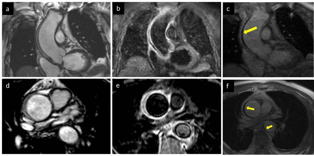 Figure 2: CMR of the ascending aorta showing the thickened aortic wall on cine steady state free precision (SSFP) imaging (a), hyperintense on T2-weighted imaging (b), and late gadolinium enhancement