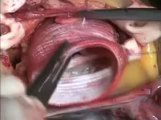 Remodeling of a bicuspid aortic valve Operative