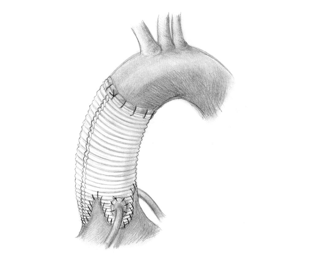 Valve sparing aortic root replacement Remodeling Sarsam/Yacoub