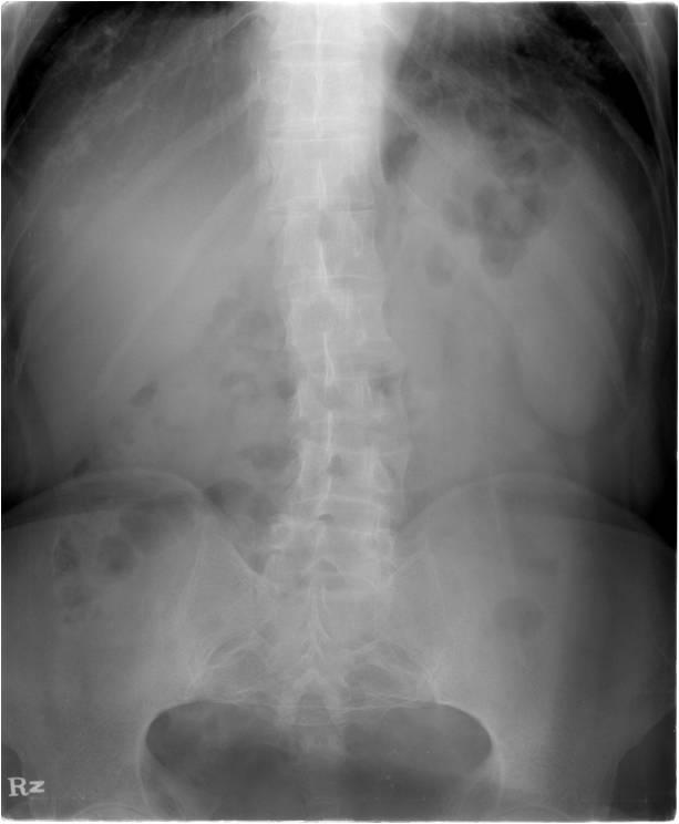 - The Korean Journal of Medicine: Vol. 84, No. 6, 2013 - ankylosing spondylitis has never been reported. Thus, we report this rare case and review the literature.
