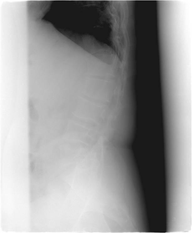 He had limited chest expansion (2 cm), but no restriction in lumbar spine In February 2007, a 33-year-old male presented with acute back pain and abdominal pain.