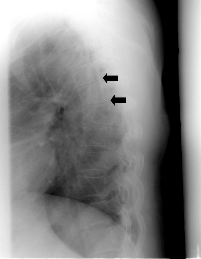 Ji Won Ryou, et al. Marfan syndrome and AS Figure 5. Computed tomography revealed Debakey type 3 aortic dissection (white arrow). Figure 3.