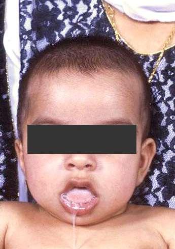 CASE On physical exam he has failure to thrive, macroglossia, mild hypotonia, increased respiratory rate, slightly dusky in color and his