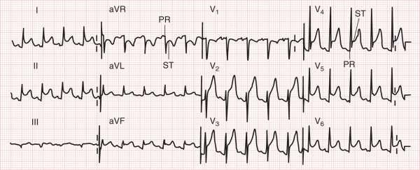 ECG (click to see results) >> Left