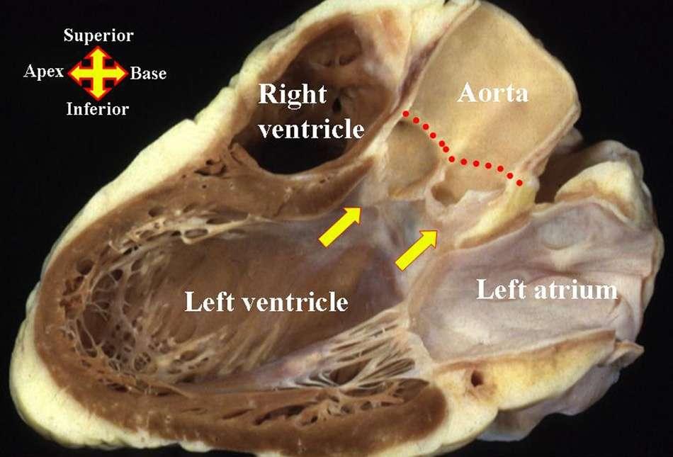 What is the aortic root?