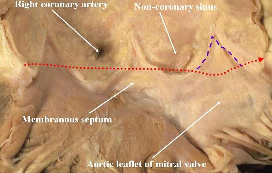 the triangle between the LC and NC aortic valvar sinuses