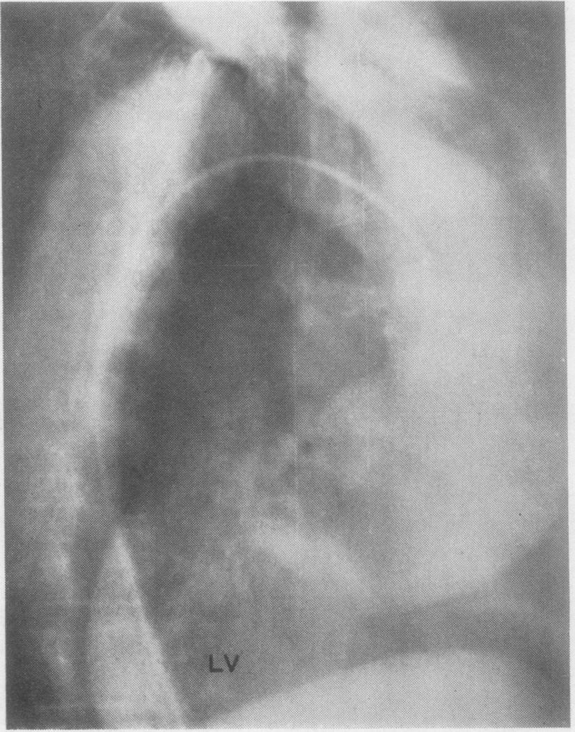Thcrax (1966), 21, 240. Surgical treatment of aneurysmal changes in the ascending aorta VIKING OLOV BJORK AND LARS BJORK Fronit thle Depart-tneiet.