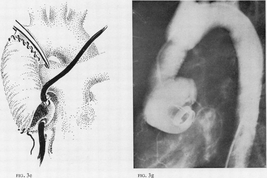 FIG. 3f Surgical treatment of aneurysmal changes in the ascending aorta FIC;. 3e FIG. 3g 243 FIG. 3. Case 3 (a) Aortogram showing an aneurysm ofthe ascending aorta, prolapsing cusps, and aortic insufficiency (arrows).