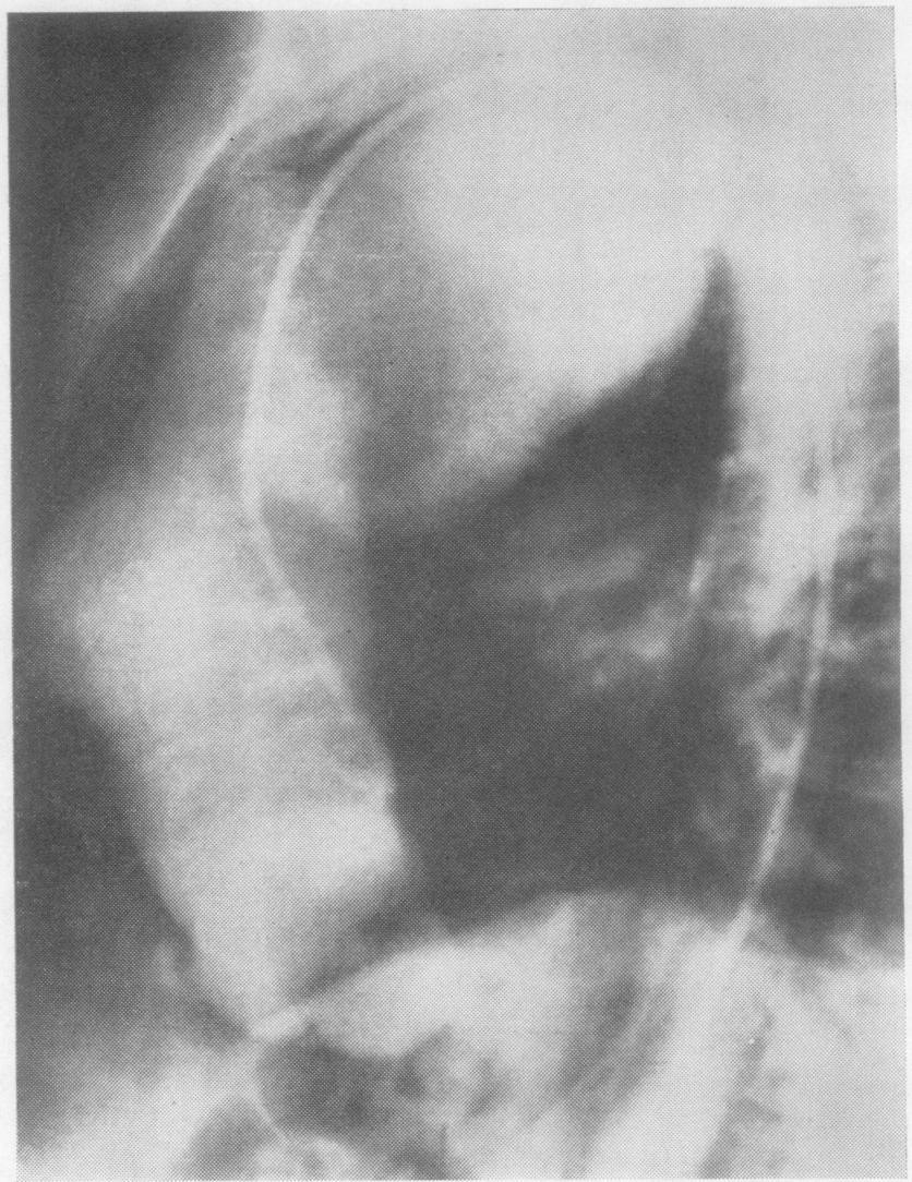 Radiographs showed a normal cardiac contour with a total volume of 760 ml.. corresponding to a relative volume of 480 ml./sq. m. body surface area.