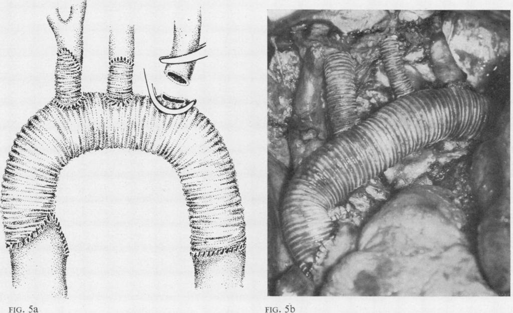 Surgical treatment of aneurysmal changes in the ascending aorta FKi. '5a c. 5b FIG. 5. Case 4 (a) Diagram of the operation with a total aortic arch replacement with a dacron graft.