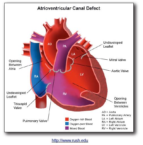 3. Atrial Septal Defect Consists of a hole in the septum between the 2 atrium.