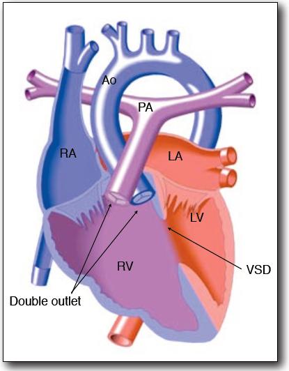 5. Double Outlet Right Ventricle A congenital defect in which both the pulmonary artery and the aorta arise from the right ventricle. 1.