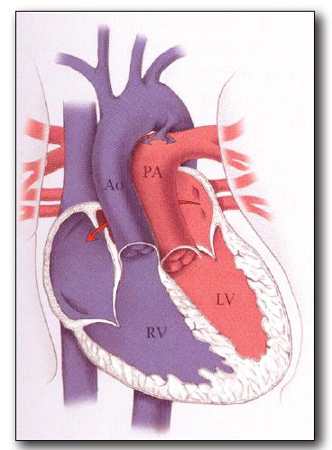4. Ebstein s Anomaly An abnormality of the tricuspid valve where two leaflets of the valve are displaced downward into the right ventricle and the third leaflet is elongated and may be tethered to