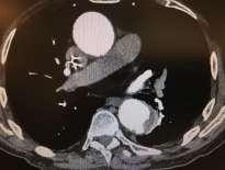 Contained Aortic Aneurysm Rupture 5.