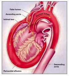 Complications Complications Malperfusion Rupture Pericardial tamponade