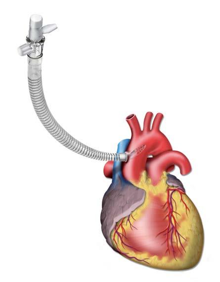 Optimized Flow Aortic Arch Cannulae Sorin Group Optiflow Cannulae has been designed with a three-dimensional basket tip for better dispersion of the flow in the blood path, improving the hemodynamics.