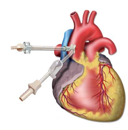 Cardioplegia Cannulae Antegrade Cardioplegia Cannulae Sorin Cardioplegia Cannulae are intended to deliver cardioplegia solutions and myocardial protection during aortic X-clamp.
