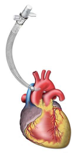 Arterial Arch Cannulae Curved Tip Aortic Arch Cannulae Sorin Aortic cannulae are offered with curved and straight tip, with non reinforced tubing and wire-reinforced tubing that present a proximal