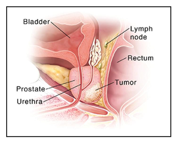 General information about prostate cancer Key points Prostate cancer is a disease in which malignant (cancer) cells form in the tissues of the prostate.