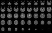 .. data analysis kept up with data acquisition! Conventional fmri analysis fmri image acquisition 1-3 seconds Has to keep up with... Real-time fmri data analysis hours, days, weeks,.