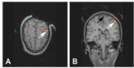 Intra-operative real-time fmri BUT: functional brain networks can change (acute plasticity due to tissue resection).