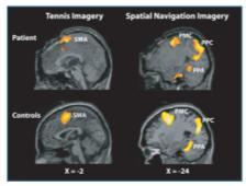 Owen, 2006, Science. Vegetative state patients might be able to communicate with fmri-based BCIs, i.e. they might benefit from the ease of learning to control a real-time fmri-based BCI.