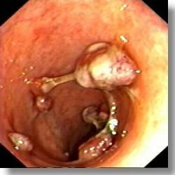 No sign of severe colitis (deep ulcers, mucosal abrasion etc.) or extensive disease Presence of multiple pseudopolyps an increased risk of CRC Beaugerie L et al.