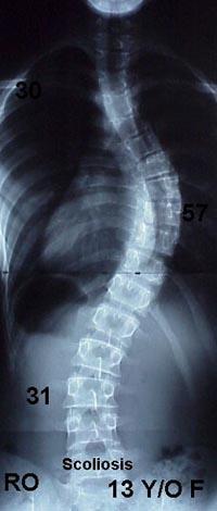 X-ray of 13 years old