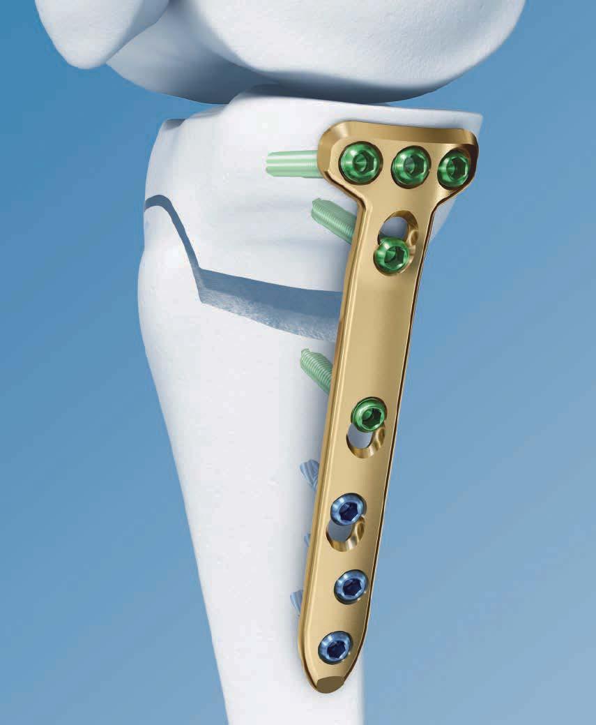 Technique Guide TomoFix Osteotomy System.