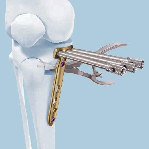 Surgical Technique Medial High Tibia Opening the osteotomy continued Instrument 395.