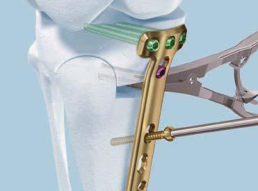 Surgical Technique Medial High Tibia 6 Insert screws into holes 1, 2, 3, 4 and D Instrument D 314.152 3.