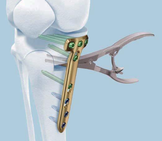 The spacers maintain adequate distance between the plate and the periosteum, help minimize damage to the blood supply, and allow the pes
